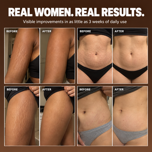 Permanently Make Your Stretch Marks Disappear or Your Money Back